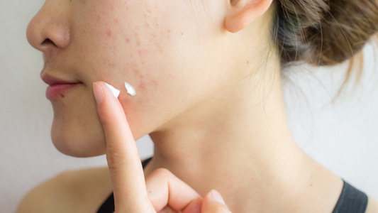 How to Layer Skincare Products for Acne-Prone Skin