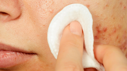 Is your skin having a meltdown? Here’s how to undo the damage!